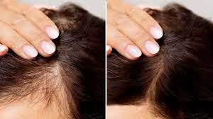 Best Hair Loss Treatment for Female - Laser Hair Removal by Dermatologist  - Bangalore Health, Personal Trainer
