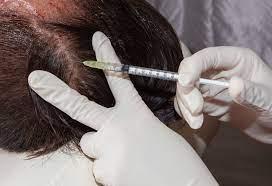 Best Hair Loss Treatment for Female - Laser Hair Removal by Dermatologist  - Bangalore Health, Personal Trainer