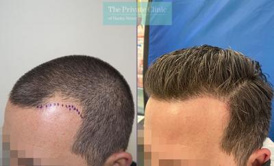 Hair Transplant in Regina - Other Other