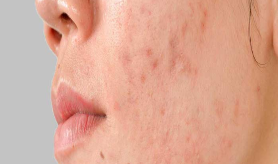 Get the Best Acne Treatment in Bangalore - Delhi Health, Personal Trainer