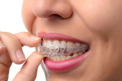 Can I eat and drink normally while wearing invisible braces? - Delhi Health, Personal Trainer