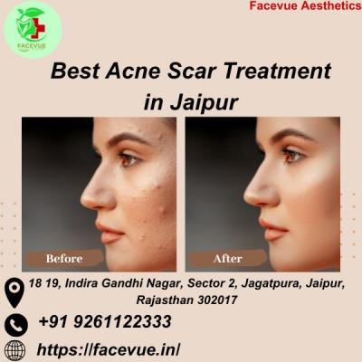 Best Acne Scar Treatment in Jaipur | Facevue - Jaipur Health, Personal Trainer