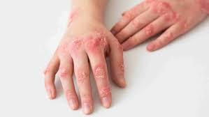Are you looking for Eczema Specialist in Mumbai? - Mumbai Health, Personal Trainer