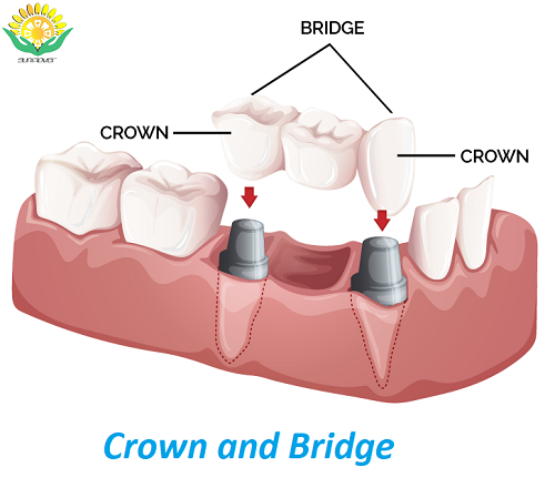 Looking for high-quality crowns and bridges made in China? - Shenzhen Other