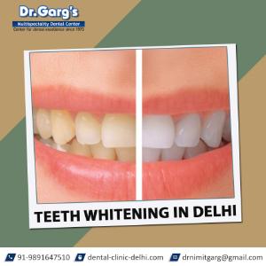Teeth Whitening in Delhi - Delhi Other