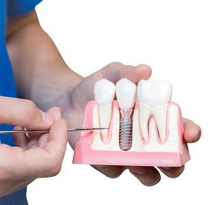 Dental Implants Preston - Melbourne Other
