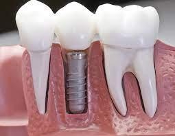 Dental Implant Services In Oakville