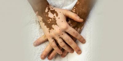 Non-Segmental Vitiligo - What is it, all you need to know about - Delhi Health, Personal Trainer
