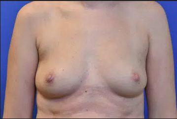 Breast Augmentation Texas - Other Health, Personal Trainer
