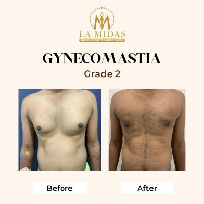 Gynecomastia surgery in Gurgaon - Gurgaon Health, Personal Trainer