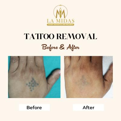 Laser tattoo removal in Gurgaon - Gurgaon Health, Personal Trainer