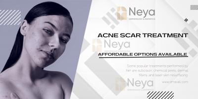 Acne Scar Treatment Cost in Hyderabad - Affordable Options Available  - Hyderabad Health, Personal Trainer