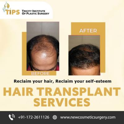Hair Transplant Surgery in Chandigarh for Natural Results - Tricity Institute of Plastic Surgery - Chandigarh Other