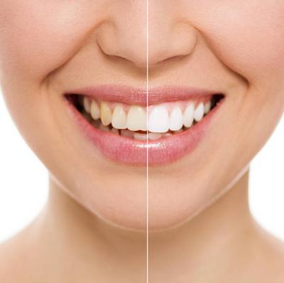 Teeth Whitening Services in Oakville - Other Health, Personal Trainer