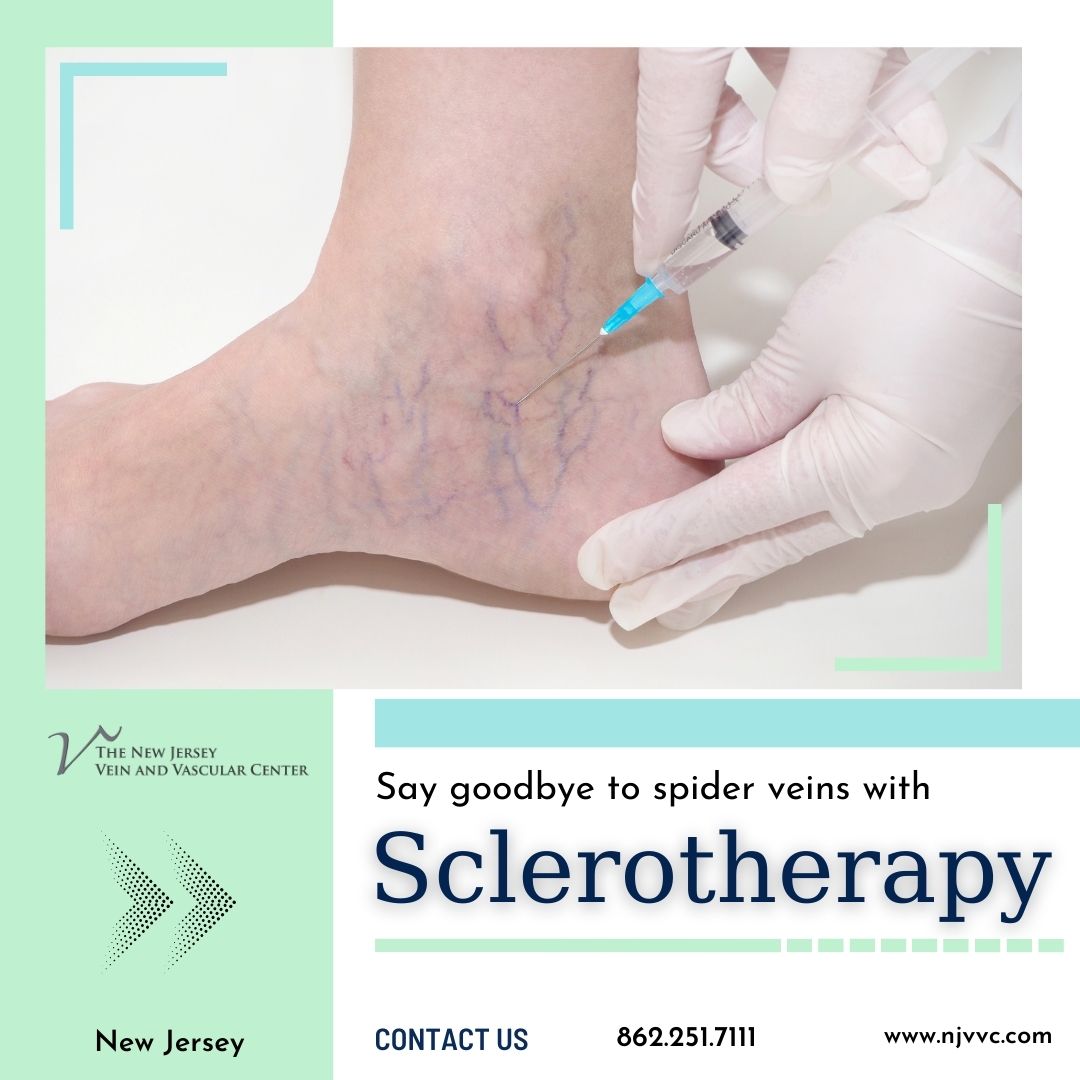 Sclerotherapy NJ - Other Health, Personal Trainer