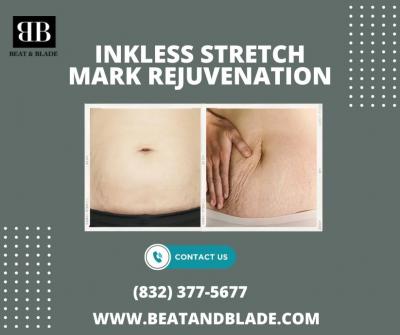 How Many Treatments Does It Take To Remove Inkless Stretch Marks? - Houston Other
