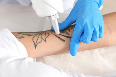 Laser Tattoo Removal Procedure: Benefits and Risks - Delhi Health, Personal Trainer