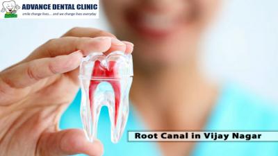 Root Canal in Vijay Nagar - Advance Dental Clinic - Delhi Other