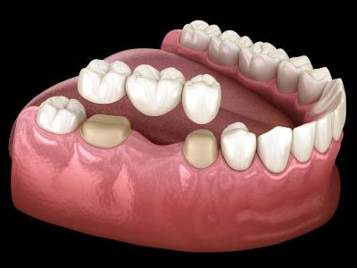 Reclaim Your Smile with Dental Crowns & Bridges! - Sydney Health, Personal Trainer
