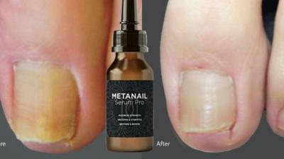 Best Nail Fungal Serum : Metanail Complex Pro  - New York Health, Personal Trainer