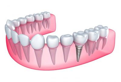 Dental implant Cost Is Now Your Pocket Friendly - Indianapolis Other