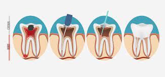 Root Canal Treatment Cost in India - Other Health, Personal Trainer