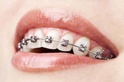 Visit AK Global Dent for the Most Affordable Braces Treatment Cost in Gurgaon