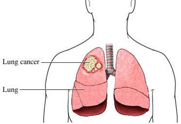 Lung Cancer Treatment in Gurgaon - Gurgaon Health, Personal Trainer