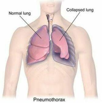 GET THE BEST PNEUMOTHORAX TREATMENT IN DELHI AT DR. HARSHVARDHAN PURI'S CLINIC