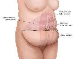 Abdominoplasty Dubai | Tummy Tuck In Dubai - Dr Rory McGoldrick - Dubai Other