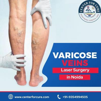 Varicose Veins Laser Surgery in Noida | Center For Cure