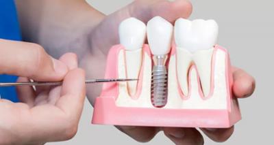 All-on-4 Dental Implants Permanent Teeth Replacement | Glastonbury, CT , Several Missing Teeth 