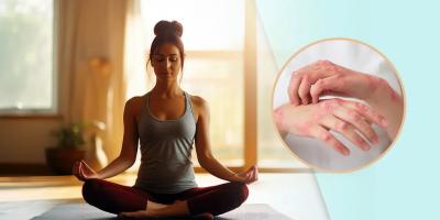 How Yoga Can Help in Psoriasis Treatment  - Delhi Health, Personal Trainer