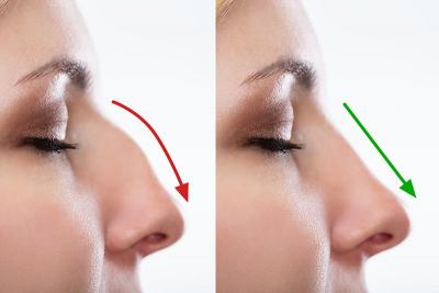 Best Rhinoplasty Surgeon in India - Expertise by Dr. Vivek Kumar - Delhi Other