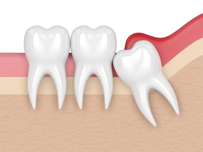 Dental Bone Grafting, Repair Teeth, Bone Grafting for Dental Implants