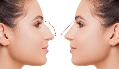 Nose Surgery Price in India: A Cost-effective Solution