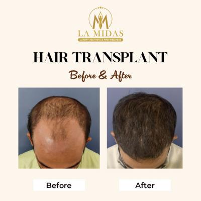Best hair transplant in Gurgaon - Gurgaon Health, Personal Trainer