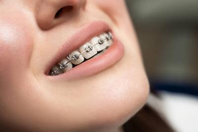 Invisalign in Oakville  - Other Health, Personal Trainer