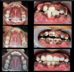The Best Orthodontist in Pune Shivajinagar: Vanilla Smiles Shines Bright - Pune Health, Personal Trainer