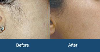 Laser hair removal cost in Gurgaon