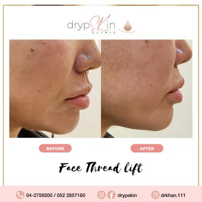 Achieve a Youthful Look with PDO Thread Lift in Dubai | DrypSkin
