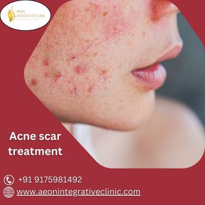 Skin Renewal Unleashed: Specialized Acne Scar Therapy - Pune Health, Personal Trainer