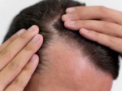 Find the Most Effective Hair Loss Treatment in Singapore - Singapore Region Health, Personal Trainer