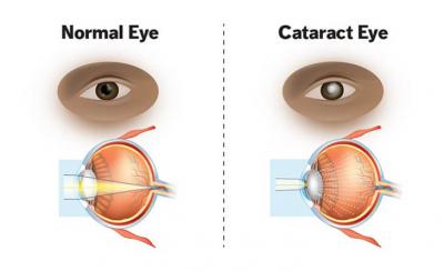 Cataract Eye Surgery | Dr. Anisha Gupta