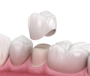 Buy Dental Crowns Online in Woodland Hills  - Other Health, Personal Trainer