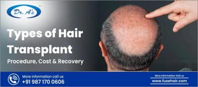 Types of Hair Transplant - Procedure, Cost & Recovery - Delhi Health, Personal Trainer