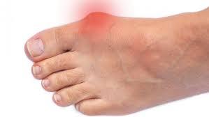 Expert Solutions for Arthritis in Feet and Ankles  - Sydney Health, Personal Trainer