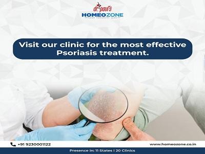 Experience Relief with Effective Psoriasis Homeopathic Treatment in Kolkata