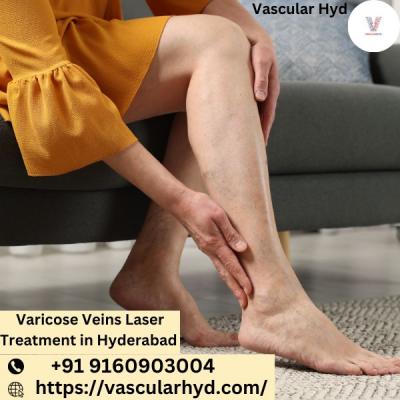 Varicose Veins Laser Treatment in Hyderabad | Vascular Hyd - Hyderabad Other