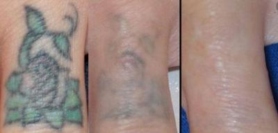 Tattoo removal in Gurgaon - Gurgaon Health, Personal Trainer